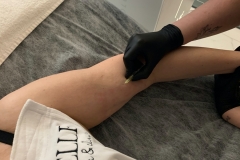 Belle-spa-clinic_karboksyterapia-obwisła-skóra-ramion