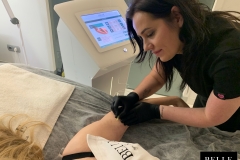 Belle-spa-clinic_obwisła-skóra-ramion