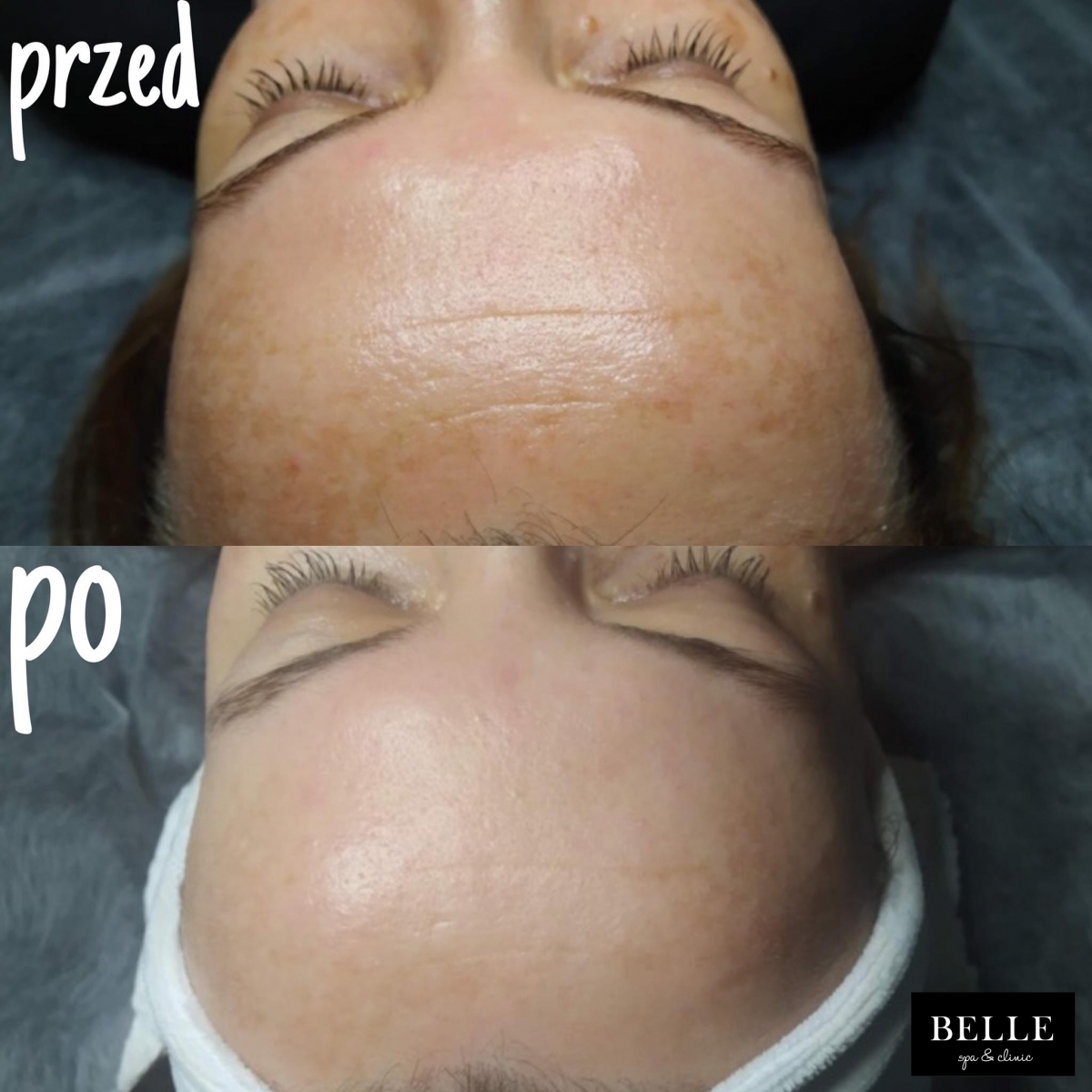 Peelingi Chemiczne Belle Spa Clinic