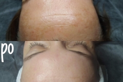 Belle-spa-clinic_efekty-kuracji-peelingami-chemicznymi