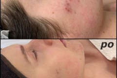 Belle-spa-clinic_peelingi-chemiczne