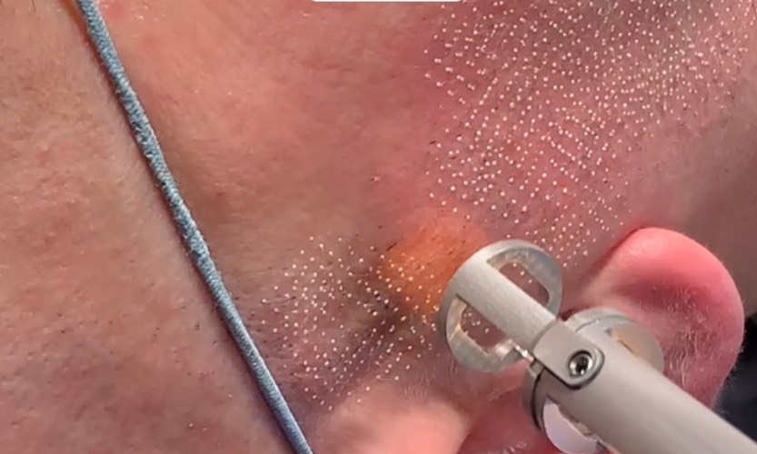 Laser frakcyjny ablacyjny Mokotów